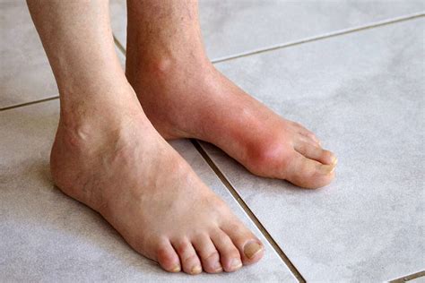 10 Symptoms of Gout in Foot