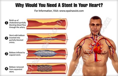 Why Would You Need A Stent In Your Heart?