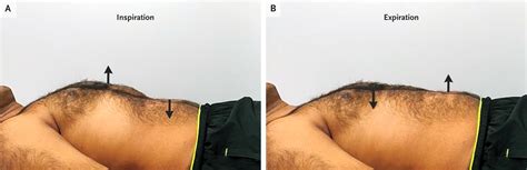 Paradoxical Abdominal Movement | NEJM