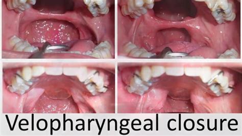 velopharyngeal closure 60 - YouTube