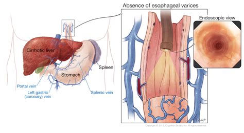 Endoscopic Variceal Banding – Dr. Indraneel Chakrabarty, MD