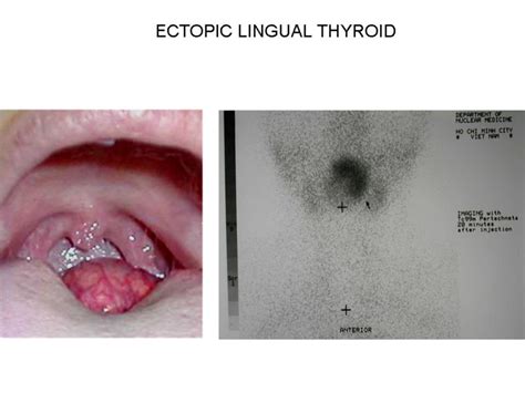 Ectopic Thyroid