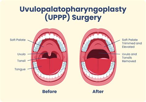 What Is UPPP Surgery?