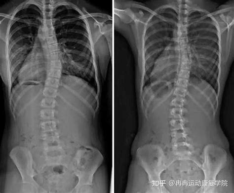 轻度脊柱侧弯可以通过什么运动恢复? - 知乎