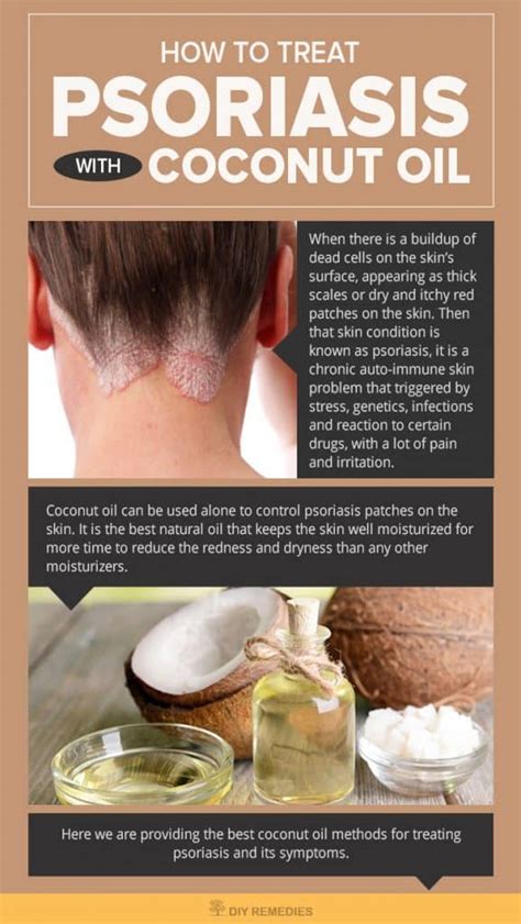 How to Treat Psoriasis with Coconut Oil