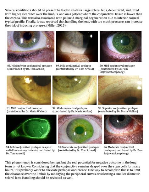 Scleral Lens Tools and Resources - GPLI