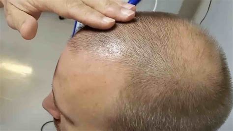 Review of stem cell hair transplant for baldness - The Niche