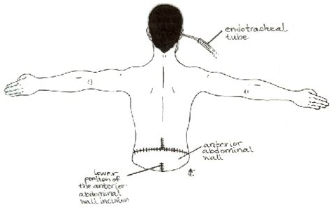 Figure 3 from An Improved Hemicorporectomy Technique | Semantic Scholar