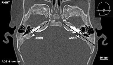 CT scan of a 4-month-old infant. MA mastoid antrum, PL, PLM,... | Download Scientific Diagram