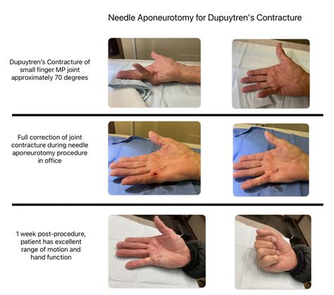 needle aponeurotomy Dupuyrens Contracture