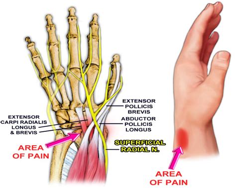 [PDF] Extensor Carpi Radialis brevis: Review of Anatomy and Clinical ...