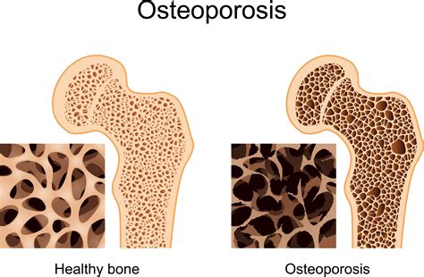 Burleigh Heads and Broadbeach Physio Centres Osteoporosis prevention & management, Gold Coast Physio