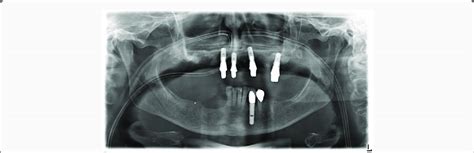 Postoperative Orthopantomogram. | Download Scientific Diagram