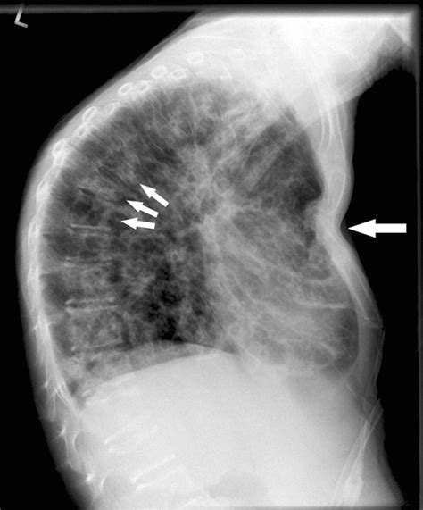 Sternal fracture with fatal outcome in cystic fibrosis | Thorax