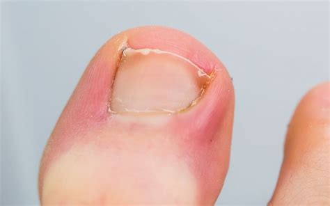 How to Treat an Infected Ingrown Toenail - MVS Podiatry Associates