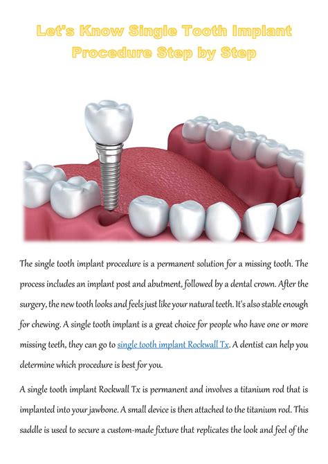 Let's Know Single Tooth Implant Procedure Step by Step by Avinash ...