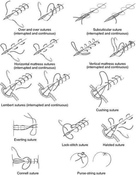 Types of sutures. - MEDizzy