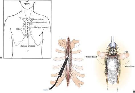 Median Sternotomy and Thymectomy | Basicmedical Key