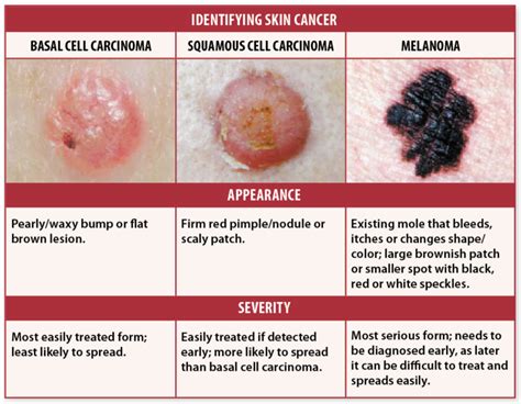 Skin Cancer Signs? Self-Checks May Help You Avoid Deadly Recurrence | University Health News