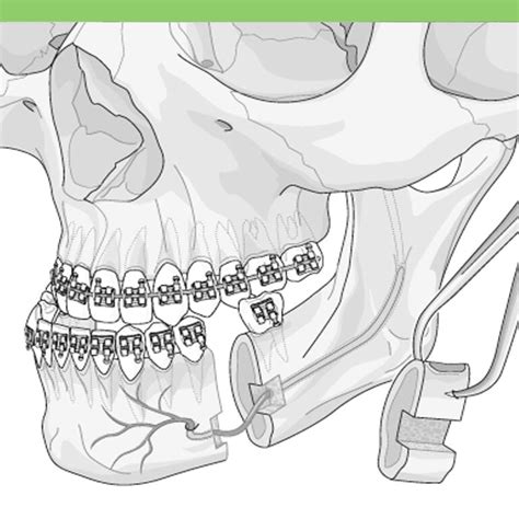 Mandibular Osteotomy - Costa Rica Dental Guide to Best Dentists