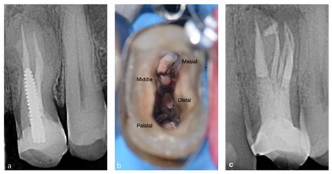 Maxillary First Premolar Canals