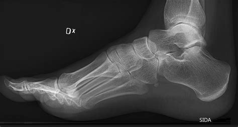 "Cavovarus deformity can occur in pediatric - Orthopaedics - www.MedicalTalk.Net the Best ...