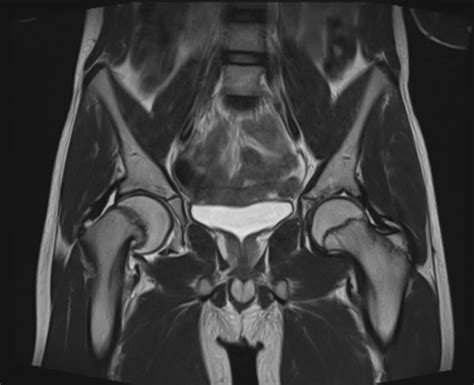 America de Nord dificil antic slipped upper femoral epiphysis scfe mri ...