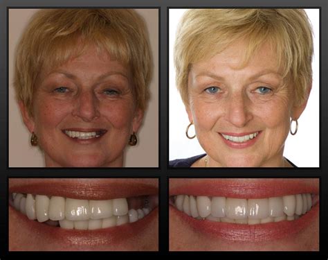 21 Dental Implant Before and After Photos