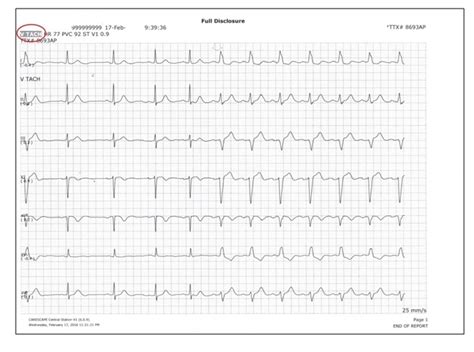 ECG Rhythms: Aberrancy