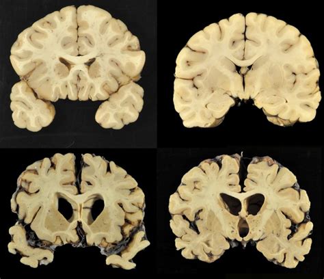 CTE Study Finds Evidence of Brain Disease in 110 Out of 111 Former NFL Players