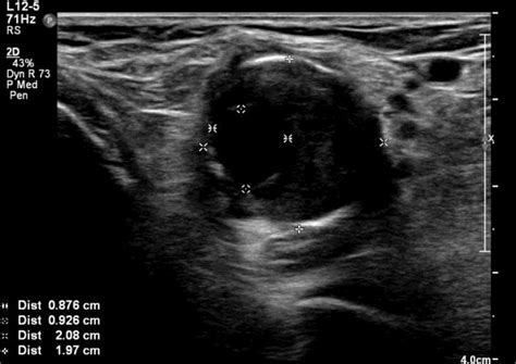 Popliteal Artery Aneurysm Ultrasound