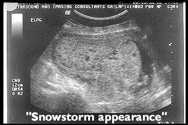 Ultrasound of Complete Molar Pregnancy