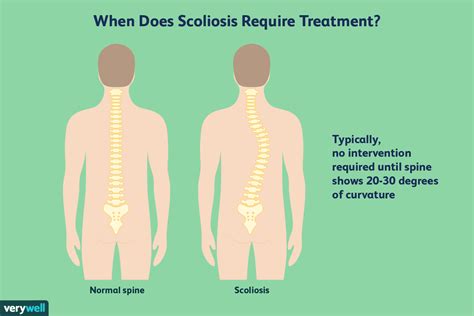 Nice Tips About How To Detect Scoliosis - Significancewall