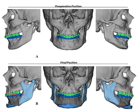 Figure 18 from Taking on the Chin - The Art of Genioplasty | Semantic Scholar