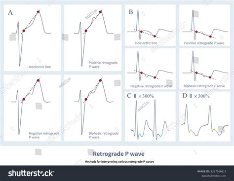 On Ecg Retrograde Pwave Can Be Stock Illustration 2287206813 | Shutterstock