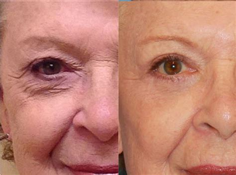 Eyelid Surgery - Upper & Lower, Blepharoplasty Surgery, Recovery