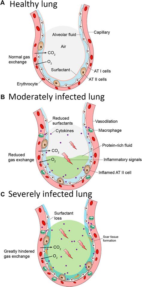 Frontiers | The Role of Pulmonary Surfactants in the Treatment of Acute Respiratory Distress ...