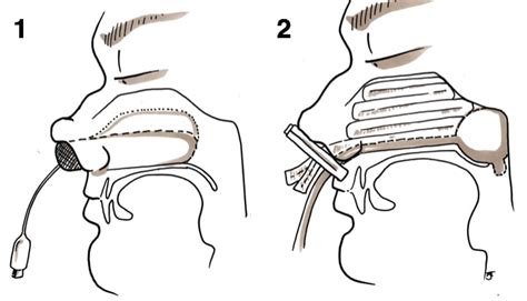 Epistaxis Pack