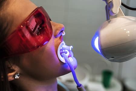 Laser Teeth Whitening: How Does It Work? | Dental.net