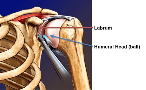 Dr Tony | Sawtooth Orthopedics | Shoulder Labral Tear Repair