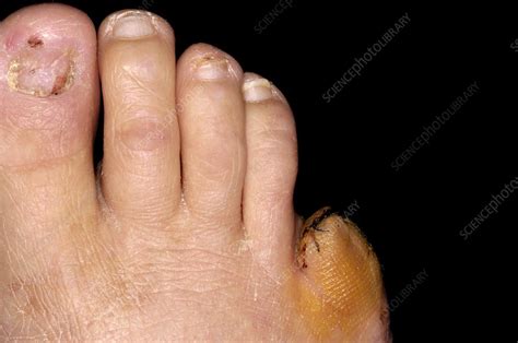 Amputated toe - Stock Image - C002/4941 - Science Photo Library