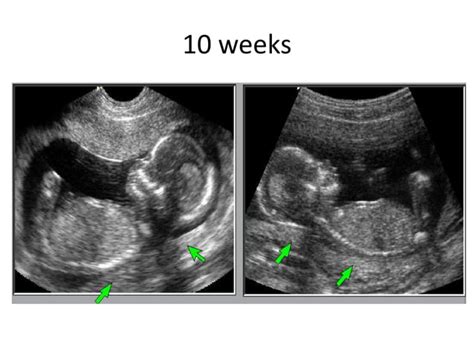 First trimester ultrasound