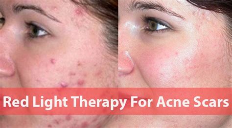 Red Light Therapy For Acne Scars