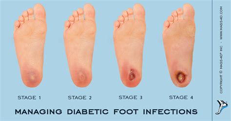 How Does A Diabetic Foot Look Like - DiabetesWalls