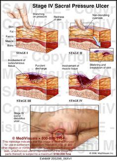 Decubitus Ulcers - Stages of Heel Decubitus Ulcer | RN proud | Pinterest | Wound care, Medical ...