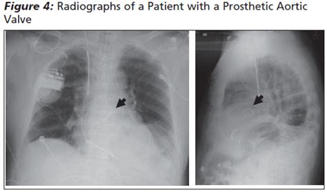 Complications of Prosthetic Heart Valves in the… | Relias Media