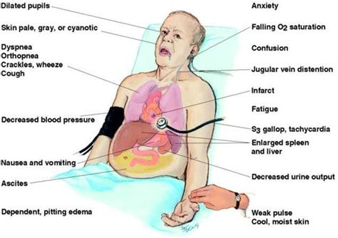 Congestive Heart Failure | Nursing notes, Nurse, Nursing study