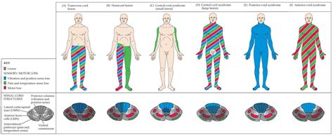 Central cord syndrome (1602×660) | Spinal cord syndromes, Spinal cord ...