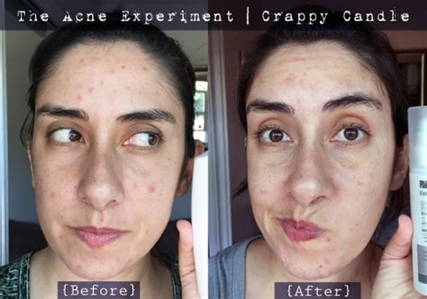 Paula's Choice Glycolic Acid Review - The Acne Experiment | Crappy Candle