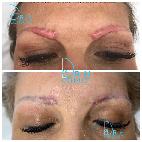 Hypertrophic Scar Treatment / Removal London | Dr H Consult